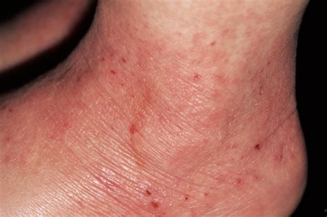 What Causes Itching With Eczema